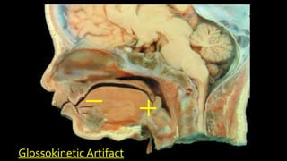 Glossokinetic Artifact
 
