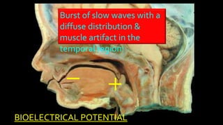 BIOELECTRICAL POTENTIAL
Burst of slow waves with a
diffuse distribution &
muscle artifact in the
temporal region!
 