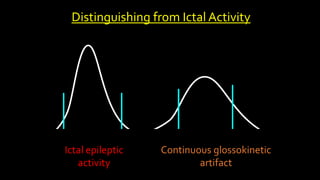 Distinguishing from Ictal Activity
Ictal epileptic
activity
Continuous glossokinetic
artifact
 