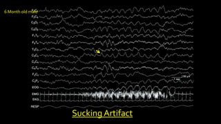 Sucking Artifact
6 Month old male
 
