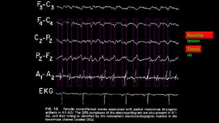 Pontine
lesion
Tinnit
us
 
