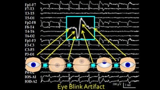 Eye Blink Artifact
 