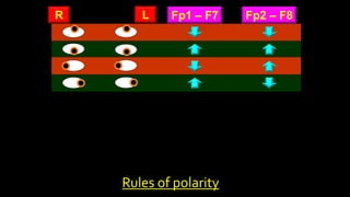 Fp1 – F7 Fp2 – F8
R L
Rules of polarity
 