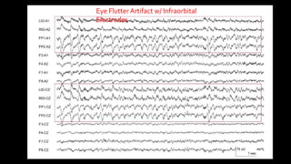 Eye Flutter Artifact w/ Infraorbital
Electrodes
 