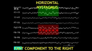 FAST COMPONENT TO THE RIGHT
HORIZONTAL
NYSTAGMUS
 