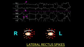 R L
3
T
LATERAL RECTUS SPIKES
 