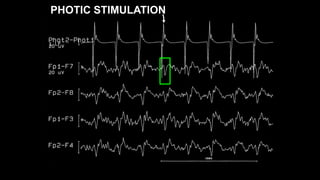 PHOTIC STIMULATION
 