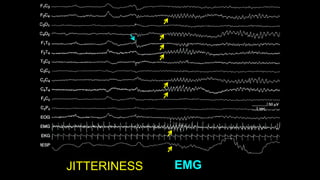 JITTERINESS EMG
 