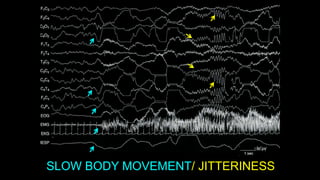 SLOW BODY MOVEMENT/ JITTERINESS
 