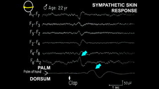 SYMPATHETIC SKIN
RESPONSE
PALM
DORSUM
 