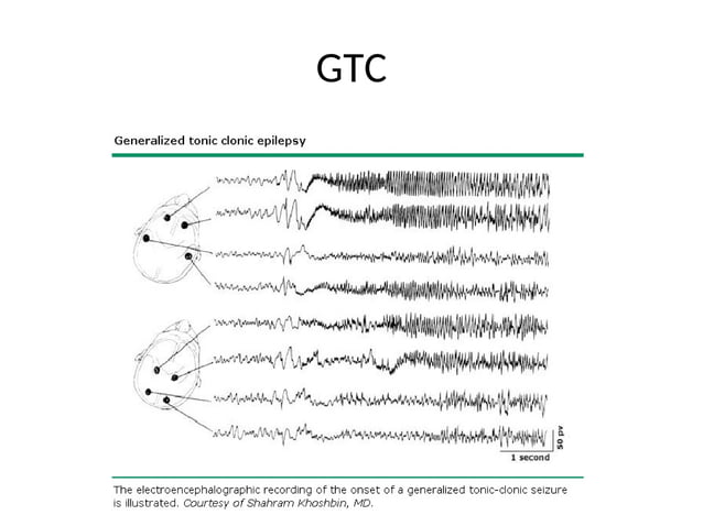 EEG interpretation for healthcare workers.ppt