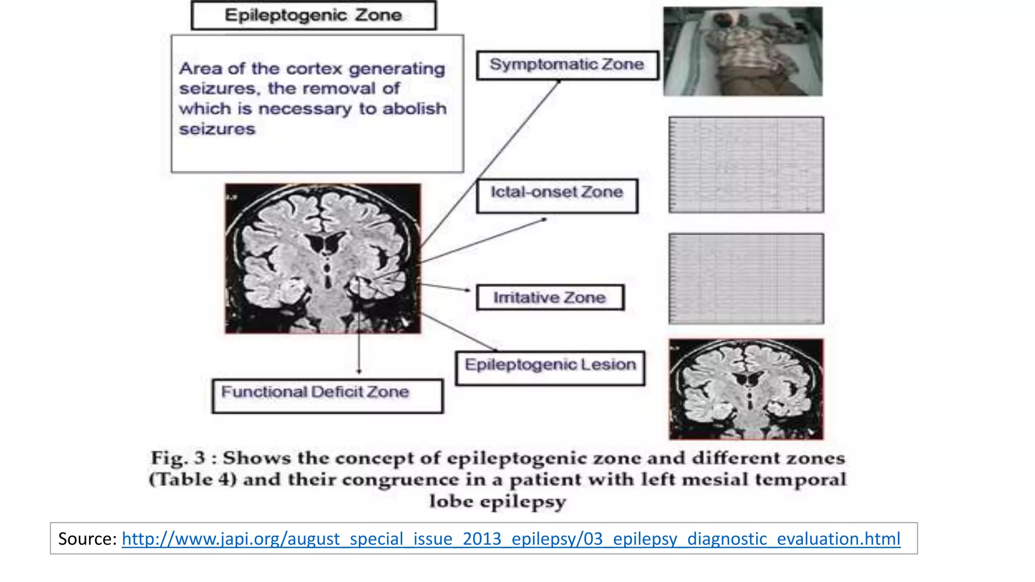 Source: http://www.japi.org/august_special_issue_2013_epilepsy/03_epilepsy_diagnostic_evaluation.html
 