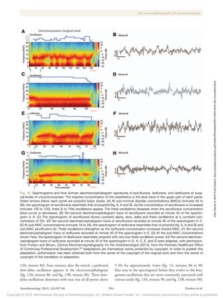 Copyright © 2015, the American Society of Anesthesiologists, Inc. Wolters Kluwer Health, Inc. Unauthorized reproduction of this article is prohibited.
Anesthesiology 2015; 123:937-60 954 Purdon et al.
Electroencephalography for Anesthesiologists
13A, minute 84). Four minutes after the switch, a profound
slow-delta oscillation appears in the electroencephalogram
(fig. 13A, minute 86, and fig. 13B, minute 86). These slow-
delta oscillations dominate with near loss of all power above
5 Hz for approximately 4min (fig. 13, minutes 86 to 90,
blue area in the spectrogram) before they evolve to the beta-
gamma oscillations that are more commonly associated with
nitrous oxide (fig. 13A, minute 90, and fig. 13B, minute 90).
Fig. 12. Spectrograms and time domain electroencephalogram signatures of sevoflurane, isoflurane, and desflurane at surgi-
cal levels of unconsciousness. The inspired concentration of the anesthetics is the blue trace in the upper part of each panel.
Green arrows below each panel are propofol bolus doses. (A) At sub-minimal alveolar concentrations (MACs) (minutes 40 to
60), the spectrogram of sevoflurane resembles that of propofol (fig. 6, A and B). As the concentration of sevoflurane is increased
(minutes 100 to 120), theta (5 to 7Hz) oscillations appear. The theta oscillations dissipate when the sevoflurane concentration
(blue curve) is decreased. (B) Ten-second electroencephalogram trace of sevoflurane recorded at minute 40 of the spectro-
gram in A. (C) The spectrogram of sevoflurane shows constant alpha, slow, delta and theta oscillations at a constant con-
centration of 3%. (D) Ten-second electroencephalogram trace of sevoflurane recorded at minute 30 of the spectrogram in C.
(E) At sub-MAC concentrations (minutes 16 to 26), the spectrogram of isoflurane resembles that of propofol (fig. 6, A and B) and
sub-MAC sevoflurane (A). Theta oscillations strengthen as the isoflurane concentration increases toward MAC. (F) Ten-second
electroencephalogram trace of isoflurane recorded at minute 40 of the spectrogram in E. (G) At the sub-MAC concentrations
shown here, the spectrogram of desflurane resembles propofol with very low theta oscillation power. (H) Ten-second electroen-
cephalogram trace of isoflurane recorded at minute 40 of the spectrogram in G. A, C, E, and G were adapted, with permission,
from Purdon and Brown, Clinical Electroencephalography for the Anesthesiologist (2014), from the Partners Healthcare Office
of Continuing Professional Development.69
Adaptations are themselves works protected by copyright. In order to publish this
adaptation, authorization has been obtained both from the owner of the copyright of the original work and from the owner of
copyright of the translation or adaptation.
Downloaded
from
http://pubs.asahq.org/anesthesiology/article-pdf/123/4/937/373943/20151000_0-00034.pdf
by
guest
on
06
May
2023
 