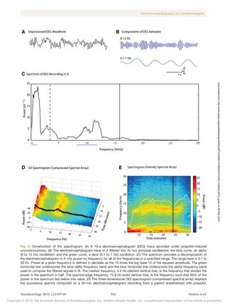 Copyright © 2015, the American Society of Anesthesiologists, Inc. Wolters Kluwer Health, Inc. Unauthorized reproduction of this article is prohibited.
Anesthesiology 2015; 123:937-60 942 Purdon et al.
Electroencephalography for Anesthesiologists
Fig. 3. Construction of the spectrogram. (A) A 10-s electroencephalogram (EEG) trace recorded under propofol-induced
unconsciousness. (B) The electroencephalogram trace in A filtered into its two principal oscillations: the blue curve, an alpha
(8 to 12 Hz) oscillation, and the green curve, a slow (0.1 to 1 Hz) oscillation. (C) The spectrum provides a decomposition of
the electroencephalogram in A into power by frequency for all of the frequencies in a specified range. The range here is 0.1 to
30 Hz. Power at a given frequency is defined in decibels as the 10 times the log base 10 of the squared amplitude. The green
horizontal line underscores the slow-delta frequency band and the blue horizontal line underscores the alpha frequency band
used to compute the filtered signals in B. The median frequency, 3.4 Hz (dashed vertical line), is the frequency that divides the
power in the spectrum in half. The spectral edge frequency, 15.9 Hz (solid vertical line), is the frequency such that 95% of the
power in the spectrum lies below this value. (D) The three-dimensional (3D) spectrogram (compressed spectral array) displays
the successive spectra computed on a 32-min electroencephalogram recording from a patient anesthetized with propofol.
Downloaded
from
http://pubs.asahq.org/anesthesiology/article-pdf/123/4/937/373943/20151000_0-00034.pdf
by
guest
on
06
May
2023
 