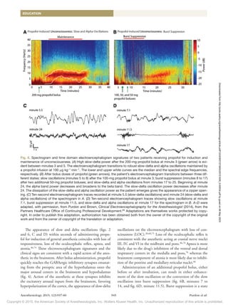 Copyright © 2015, the American Society of Anesthesiologists, Inc. Wolters Kluwer Health, Inc. Unauthorized reproduction of this article is prohibited.
Anesthesiology 2015; 123:937-60 945 Purdon et al.
EDUCATION
The appearance of slow and delta oscillations (figs. 2
and 6, C and D) within seconds of administering propo-
fol for induction of general anesthesia coincides with loss of
responsiveness, loss of the oculocephalic reflex, apnea, and
atonia.46,74
These electroencephalogram signatures and the
clinical signs are consistent with a rapid action of the anes-
thetic in the brainstem. After bolus administration, propofol
quickly reaches the GABAergic inhibitory synapses emanat-
ing from the preoptic area of the hypothalamus onto the
major arousal centers in the brainstem and hypothalamus
(fig. 4). Action of the anesthetic at these synapses inhibits
the excitatory arousal inputs from the brainstem, favoring
hyperpolarization of the cortex, the appearance of slow-delta
oscillations on the electroencephalogram with loss of con-
sciousness (LOC).20,60,75
Loss of the oculocephalic reflex is
consistent with the anesthetic acting at cranial nerve nuclei
III, IV, and VI in the midbrain and pons.46,74
Apnea is most
likely due to the drug’s inhibition of the ventral and dorsal
respiratory centers in the medulla and pons,76
whereas the
brainstem component of atonia is most likely due to inhibi-
tion of the pontine and medullary reticular nuclei.46
Administration of an additional propofol bolus, either
before or after intubation, can result in either enhance-
ment of the slow oscillation or the conversion of the slow
oscillation into burst suppression (fig. 6B, minutes 7 to
14, and fig. 6D, minute 11.5). Burst suppression is a state
Fig. 6. Spectrogram and time domain electroencephalogram signatures of two patients receiving propofol for induction and
maintenance of unconsciousness. (A) High slow-delta power after the 200-mg propofol bolus at minute 3 (green arrow) is evi-
dent between minutes 3 and 5. The electroencephalogram transitions to robust slow-delta and alpha oscillations maintained by
a propofol infusion at 100 μg kg−1
min−1
. The lower and upper white curves are the median and the spectral edge frequencies,
respectively. (B) After bolus doses of propofol (green arrows), the patient’s electroencephalogram transitions between three dif-
ferent states: slow oscillations (minutes 5 to 8) after the 100-mg propofol bolus at minute 3; burst suppression (minutes 8 to 17)
after two additional 50-mg propofol boluses; and slow-delta and alpha oscillations from minutes 17 to 25. Beginning at minute
24, the alpha band power decreases and broadens to the beta band. The slow-delta oscillation power decreases after minute
24. The dissipation of the slow-delta and alpha oscillation power as the patient emerges gives the appearance of a zipper open-
ing. (C) Ten-second electroencephalogram traces recorded at minute 5.5 (slow-delta oscillations) and minute 24 (slow-delta and
alpha oscillations) of the spectrogram in A. (D) Ten-second electroencephalogram traces showing slow oscillations at minute
7.1, burst suppression at minute 11.5, and slow-delta and alpha oscillations at minute 17 for the spectrogram in B. A–D were
adapted, with permission, from Purdon and Brown, Clinical Electroencephalography for the Anesthesiologist (2014), from the
Partners Healthcare Office of Continuing Professional Development.69
Adaptations are themselves works protected by copy-
right. In order to publish this adaptation, authorization has been obtained both from the owner of the copyright of the original
work and from the owner of copyright of the translation or adaptation. Downloaded
from
http://pubs.asahq.org/anesthesiology/article-pdf/123/4/937/373943/20151000_0-00034.pdf
by
guest
on
06
May
2023
 