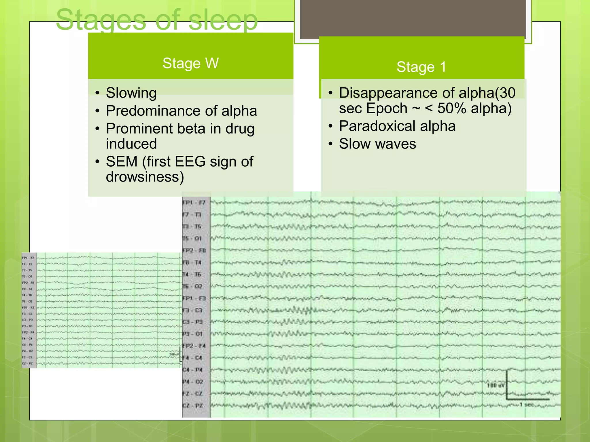 Stages of sleep
Stage W
• Slowing
• Predominance of alpha
• Prominent beta in drug
induced
• SEM (first EEG sign of
drowsiness)
Stage 1
• Disappearance of alpha(30
sec Epoch ~ < 50% alpha)
• Paradoxical alpha
• Slow waves
 