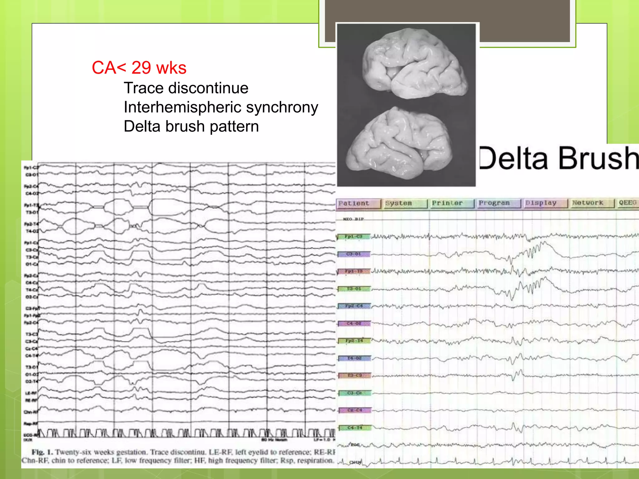 CA< 29 wks
Trace discontinue
Interhemispheric synchrony
Delta brush pattern
 