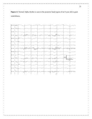 21
Figure-1: Normal Alpha rhythm is seen in the posterior head region of an 8 year old in quiet
wakefulness.
 