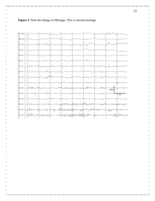 22
Figure 2: Note the change in Montage. This is coronal montage
 