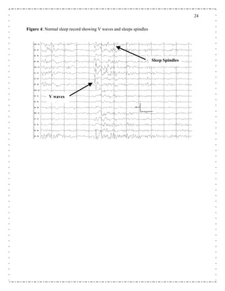 24
Figure 4: Normal sleep record showing V waves and sleeps spindles
Sleep Spindles
V waves
 