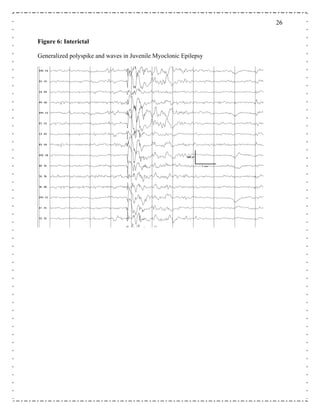 2626
Figure 6: Interictal
Generalized polyspike and waves in Juvenile Myoclonic Epilepsy
 