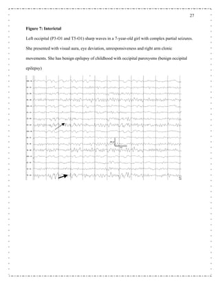 27
Figure 7: Interictal
Left occipital (P3-O1 and T5-O1) sharp waves in a 7-year-old girl with complex partial seizures.
She presented with visual aura, eye deviation, unresponsiveness and right arm clonic
movements. She has benign epilepsy of childhood with occipital paroxysms (benign occipital
epilepsy)
 
