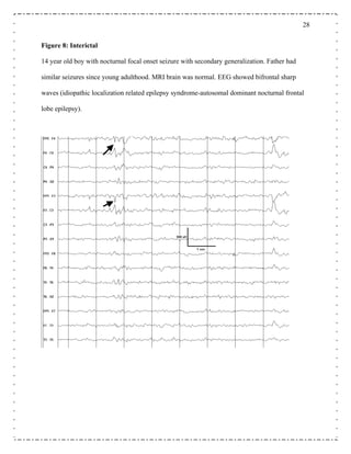 28
Figure 8: Interictal
14 year old boy with nocturnal focal onset seizure with secondary generalization. Father had
similar seizures since young adulthood. MRI brain was normal. EEG showed bifronta
waves (idiopathic localization related epilepsy syndrome-autosomal dominant nocturnal fronta
lobe epilep
l sharp
l
sy).
 