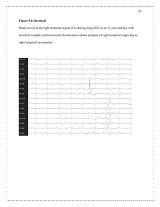 29
Figure 9A:Interictal
Sharp waves in the right temporal region (T4) during sleep EEG in an 11-year-old boy with
recurrent complex partial seizures (localization related epilepsy of right temporal origin due to
right temporal cavernoma)
 