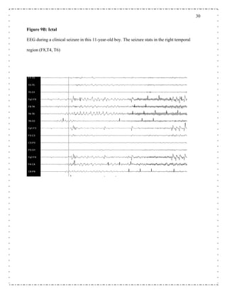 30
Figure 9B: Ictal
EEG during a clinical seizure in this 11-year-old boy. The seizure stats in the right temporal
region (F8,T4, T6)
 
