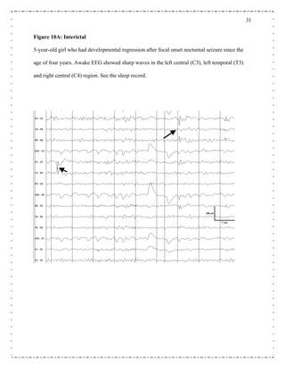 31
Figure 10A: Interictal
wake EEG showed sharp waves in the left central (C3), left temporal (T3)
nd right central (C4) region. See the sleep record.
5-year-old girl who had developmental regression after focal onset nocturnal seizure since the
age of four years. A
a
 