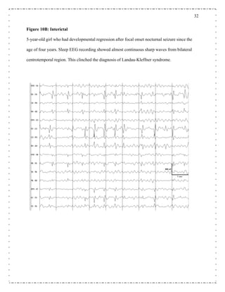 32
f Landau-Kleffner syndrome.
Figure 10B: Interictal
5-year-old girl who had developmental regression after focal onset nocturnal seizure since the
age of four years. Sleep EEG recording showed almost continuous sharp waves from bilateral
centrotemporal region. This clinched the diagnosis o
 