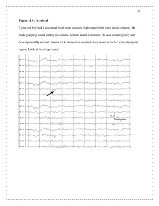 33
Figure 11A: Interictal
7 year old boy had 2 nocturnal focal onset seizures (right upper limb tonic clonic seizure). He
made gurgling sound during the seizure. Seizure lasted 4 minutes. He was neurologically and
developmentally normal. Awake EEG showed an isolated sharp wave in the left centrotemporal
gion. Look at the sleep recordre
 