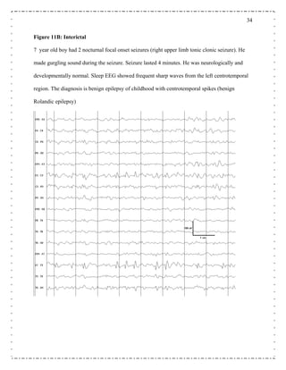 34
pilepsy of childhood with centrotemporal spikes (benign
olandic epilepsy)
Figure 11B: Interictal
7 year old boy had 2 nocturnal focal onset seizures (right upper limb tonic clonic seizure). He
made gurgling sound during the seizure. Seizure lasted 4 minutes. He was neurologically and
developmentally normal. Sleep EEG showed frequent sharp waves from the left centrotemporal
region. The diagnosis is benign e
R
 