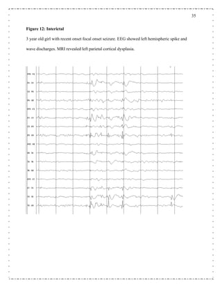 35
Figure 12: Interictal
3 year old girl with recent onset focal onset seizure. EEG showed left hemispheric spike and
wave discharges. MRI revealed left parietal cortical dysplasia.
 