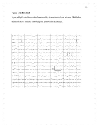 3636
igure 13A: Interictal
9-year-old girl with history of 4-5 nocturnal focal onset tonic clonic seizures. EEG before
treatment shows bilateral centrotemporal epileptiform discharges.
F
 