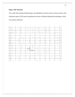 37
Figure 13B: Interictal
ith
al epileptiform discharges, which
were almost continuous.
Two weeks after starting Carbamazepine, she had plenty of seizures and was always drowsy w
incoherent speech. EEG showed significant activation of bilater
 