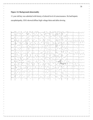 38
Figure 14: Background abnormality
lowing
11 year old boy was admitted with history of altered level of consciousness. He had hepatic
encephalopathy. EEG showed diffuse high voltage theta and delta s
 