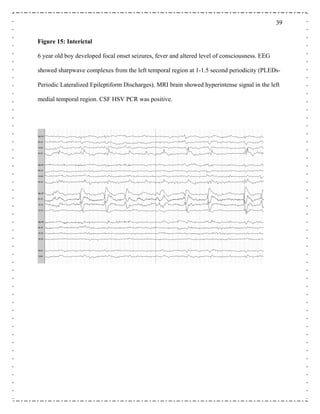 3939
igure 15: Interictal
6 year old boy developed focal onset seizures, fever and altered level of consciousness. EEG
showed sharpwave complexes from the left temporal region at 1-1.5 second periodicity (PLEDs-
Periodic Lateralized Epileptiform Discharges). MRI brain showed hyperintense signal in the left
medial temporal region. CSF HSV PCR was positive.
F
 