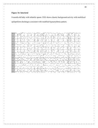 40
Figure 16: Interictal
8-month-old baby with infantile spasm. EEG shows chaotic background activity with multifocal
epileptiform discharges consistent with modified hypsarrythmia pattern.
 