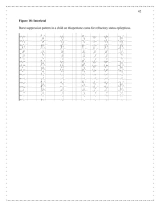 42
Figure 18: Interictal
Burst suppression pattern in a child on thiopentone coma for refractory status epilepticus.
 