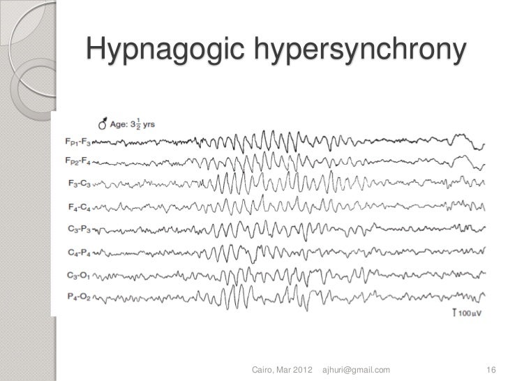 Eeg For Sleep Lab Eeg For Sleep Lab