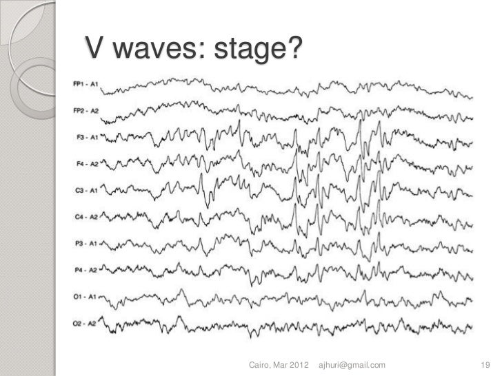 Eeg For Sleep Lab Eeg For Sleep Lab