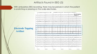 Artifacts Found in EEG (3)
Electrode Tapping
Artifact
With ambulatory EEG recording, there may be periods in which the patient
is scratching or pressing on the scalp electrodes.
 