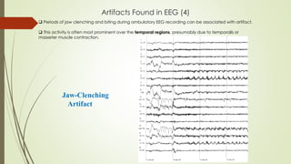 Artifacts Found in EEG (4)
Jaw-Clenching
Artifact
 Periods of jaw clenching and biting during ambulatory EEG recording can be associated with artifact.
 This activity is often most prominent over the temporal regions, presumably due to temporalis or
masseter muscle contraction.
 