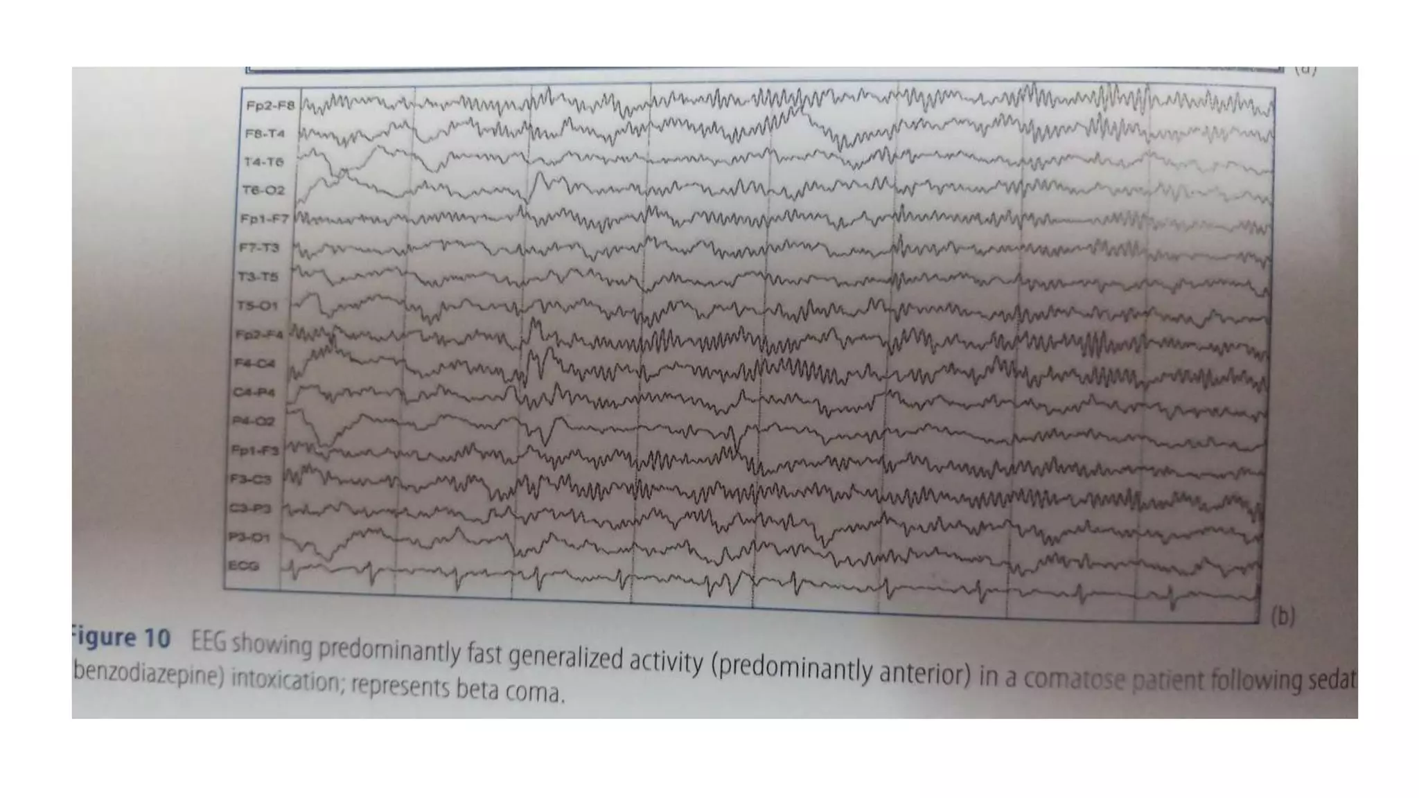 Eeg in encephalopathy | PPTX
