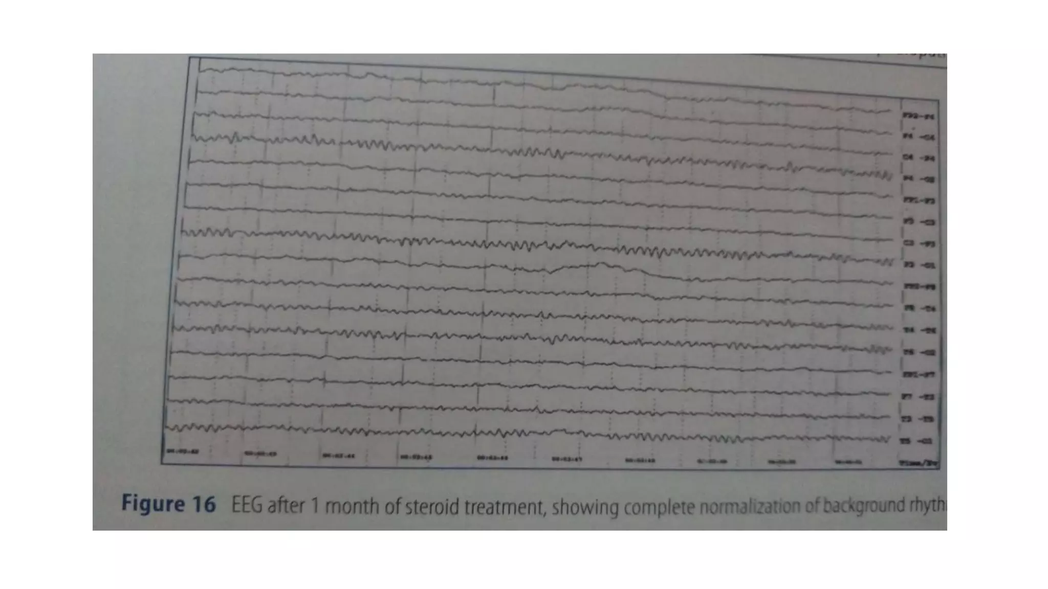Eeg in encephalopathy | PPTX