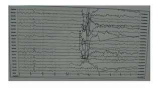 Eeg in encephalopathy | PPTX