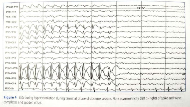 epilepsy eeg vs normal eeg epilepsy eeg vs normal eeg