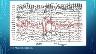 EEG Lecture 3: Artifacts and Benign EEG variants | PPTX