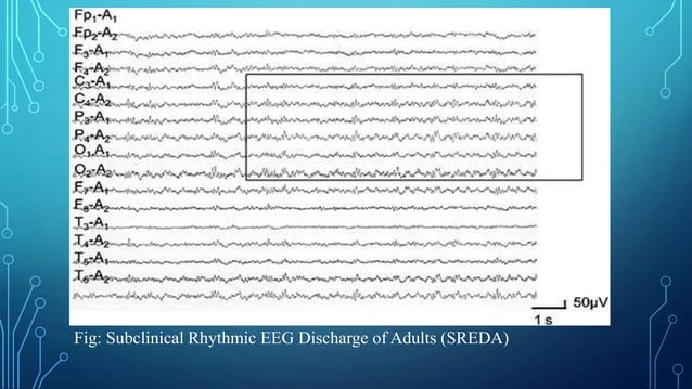 EEG Lecture 3: Artifacts and Benign EEG variants | PPTX